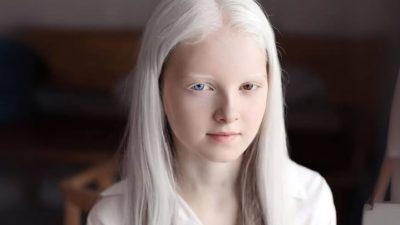 Amina Eppendieva, Gadis Albino Rusia dengan Pesona Unik: Rambut Putih, Mata Coklat dan Biru